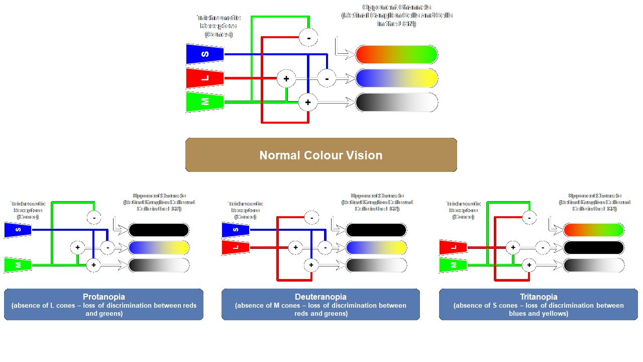 Simplified neural circuits underlying normal colour vision and dichromacies